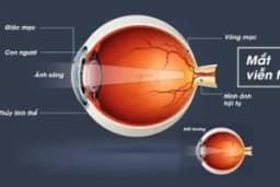 Tật viễn thị (Bạn có bị viễn thị không?): Triệu chứng và cách điều trị