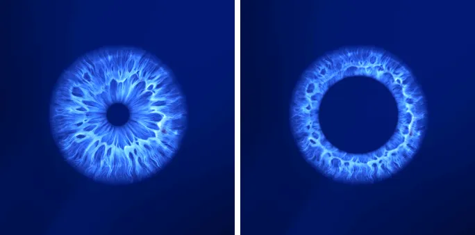 Đồng tử co nhỏ khi sáng (trái) và mở to khi tối (phải) — hình minh hoạ của Essilor