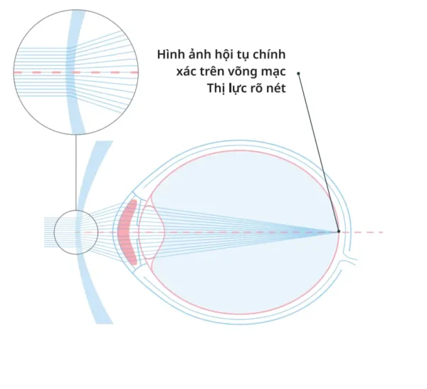 Tròng kính kiểm soát cận thị Essilor Stellest - Hình ảnh 3