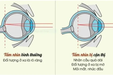 Cận thị Nguyên nhân, tiến triển và cách điều trị